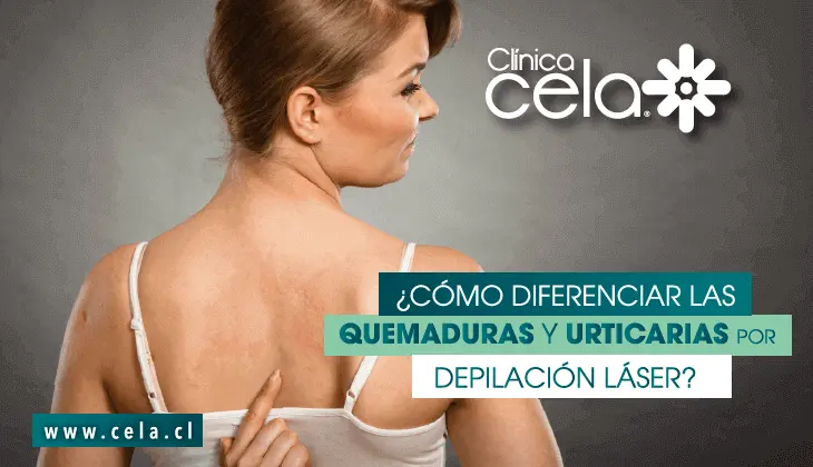 ¿Cómo diferenciar quemaduras y urticarias por depilación láser?
