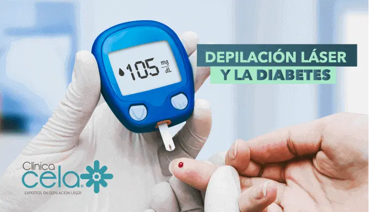 Depilación láser o fotodepilación y la diabetes