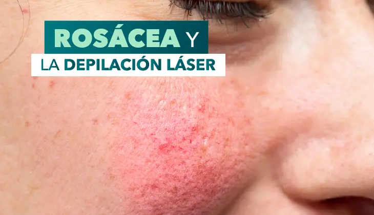 Rosácea y depilación láser, ¿son compatibles?